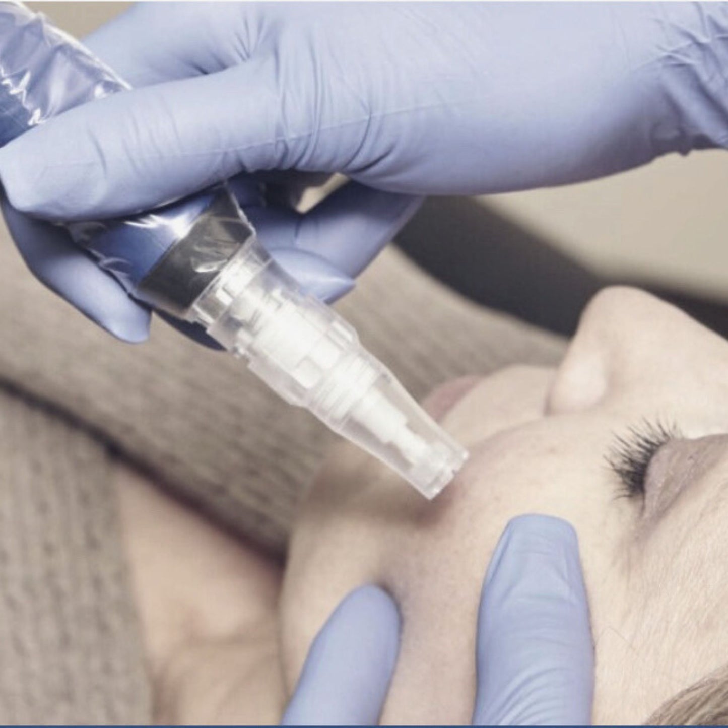 Microneedling